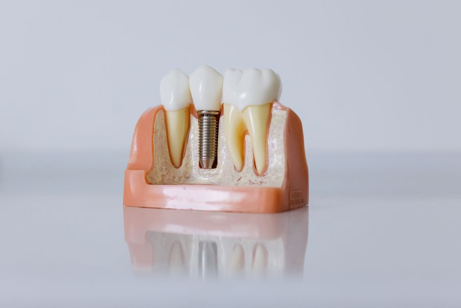 Local SEO for Dental Implant Specialists: A Masterclass in Getting Found
